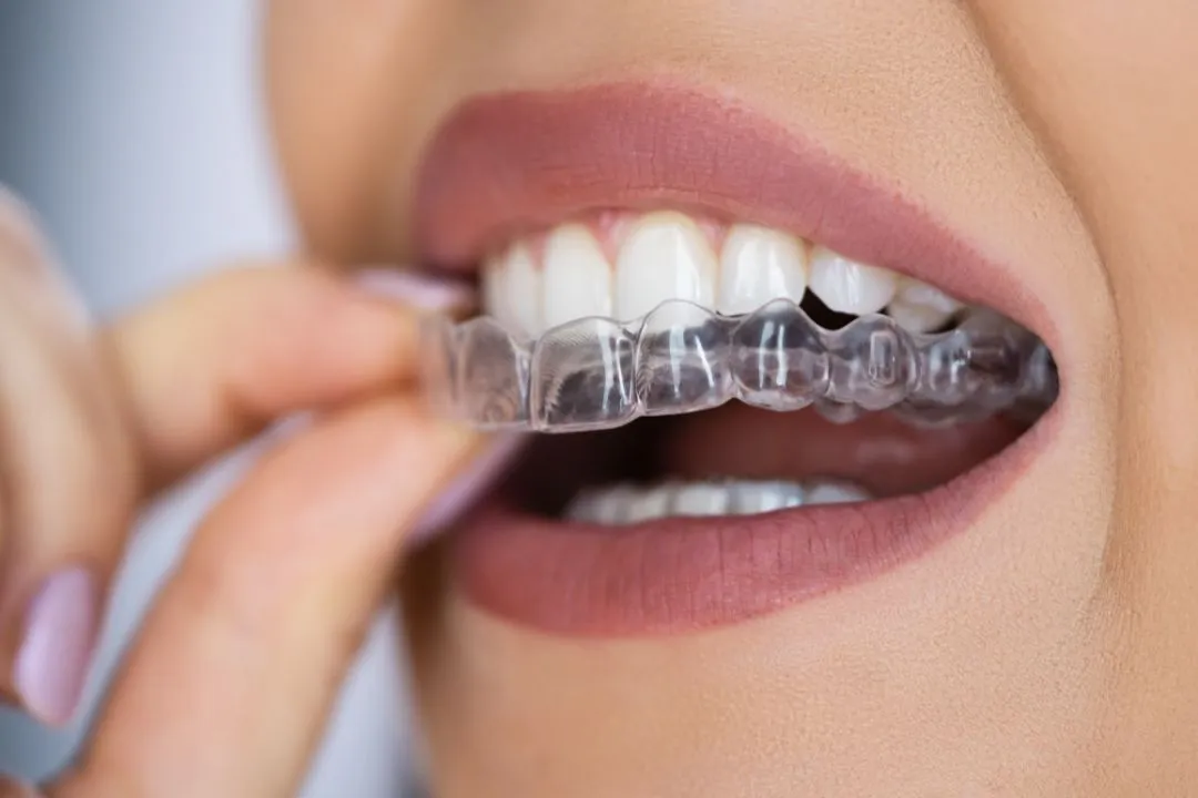 Aligners, Braces and Retainers care 2